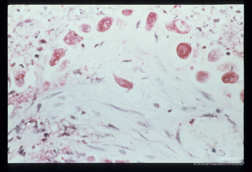 Best carmine stained section of rectum with suggestion of vessel invasion.