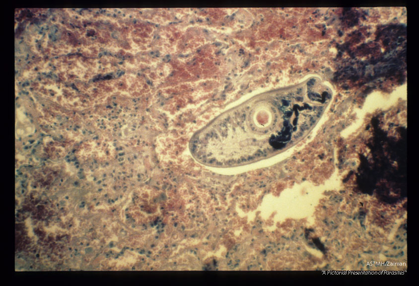Autopsied human lung showing hemorrhagic pneumonia and the etiologic agent, a mesocercaria in the patient's lung.