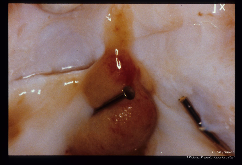 Polypoid patch at ureterovesical junction in an experimentally infected chimpanzee. Nails were placed in the ureteral orifices.