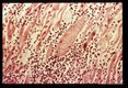 Section of myocardium showing numerous parasites, edema, and inflammatory infiltrate.