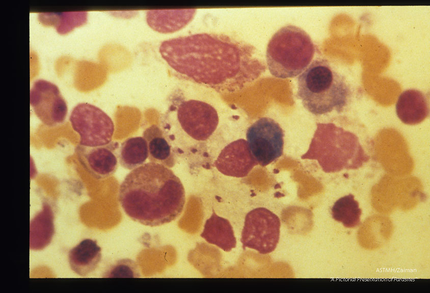 Diffuse cutaneous leishmaniasis. Amastigotes in bone marrow.