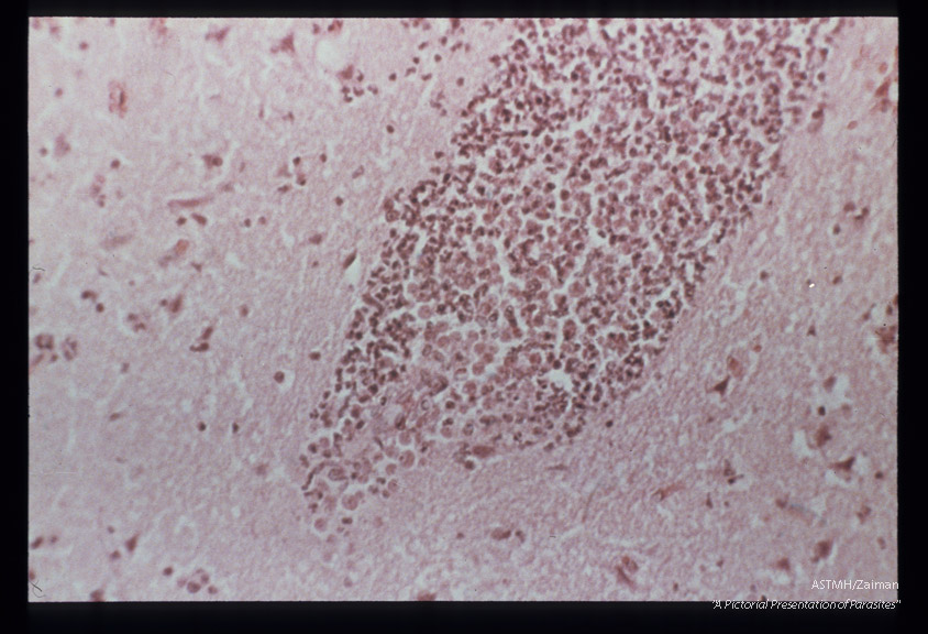 Meningitis- Hematoxylin-eosin stained section of human brain at various magnifications.