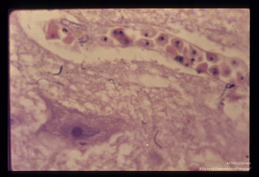 Numerous infected red blood cells in brain capillary.