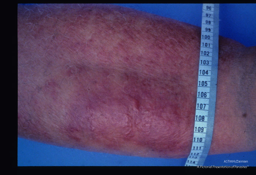Cellulitis and elephantiasis of the right leg of seventy-seven year old female. An attack began four days earlier. Case acquired thirty years ago.