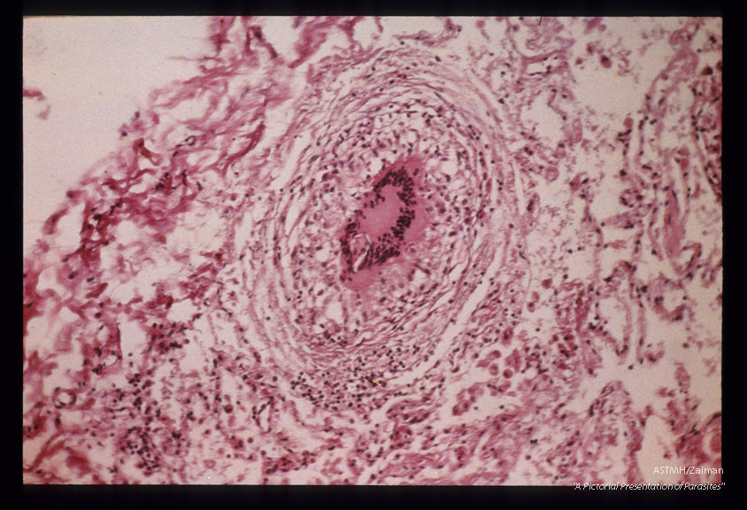 H & E stained lung section from a fatal case of pulmonary schistosomiasis. Granuloma containing egg shell and giant cell is shown.