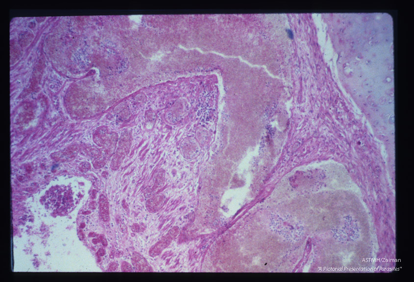 Chronic necrotizing inflammatory reaction in bronchial wall.