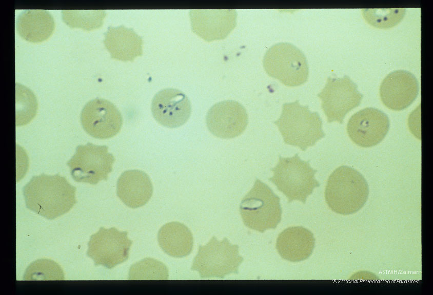 Giemsa stained slides from a fatal case on Fire Island, N. Y., (1982). The parasitemia is high for human babesiosis. Budding, multiply-infected erythrocytes, tetrad formation, band forms, reticulocytosis and clumping of extracellular parasites may be seen.