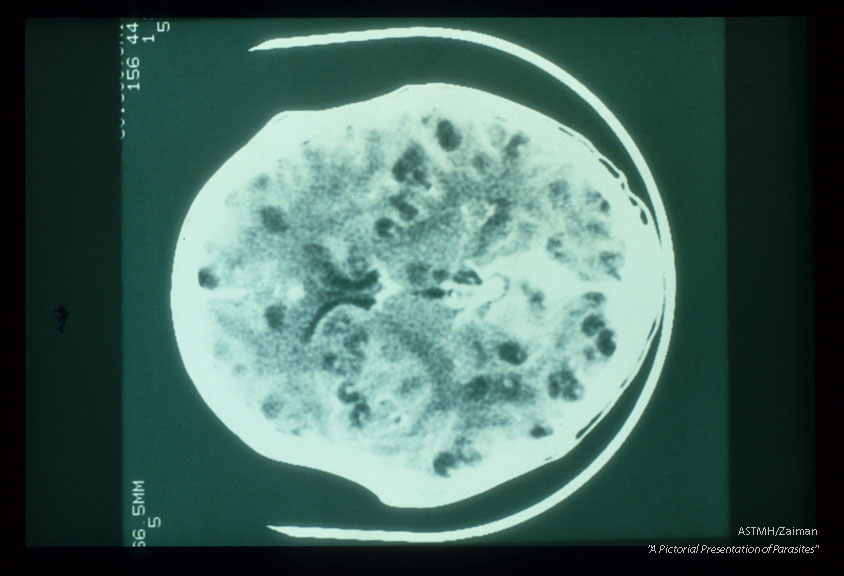 A CAT scan of the skull shows multiple small, rounded, dark lucencies in the brain. These are cysticerci. Some show central, white calcific dots which are scolices. Some show peripheral calcifications. Midline bird-like and linear dark lucencies represent the ventricular system. Midline white calcific densities are probably vascular structures.