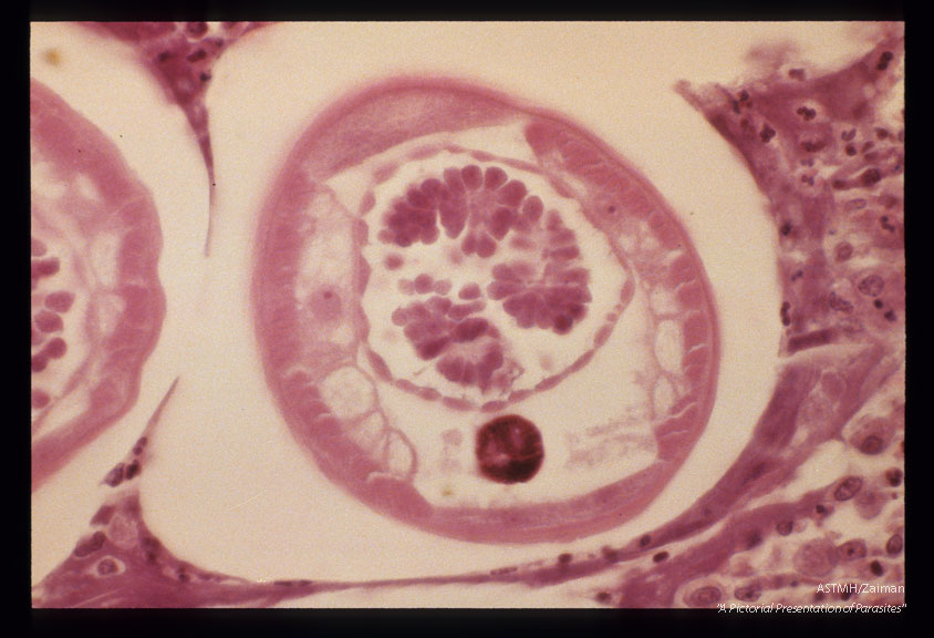 Section of a male worm in a nodule. Liberia.