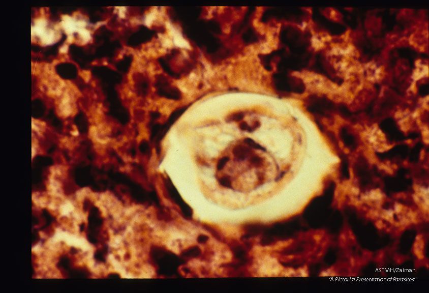 Sections through larvae in retinal granulomas (human case).