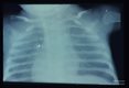 X-ray of child with pneumonia showing the characteristic ground glass appearance of such lungs.