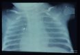 X-ray of child with pneumonia showing the characteristic ground glass appearance of such lungs.