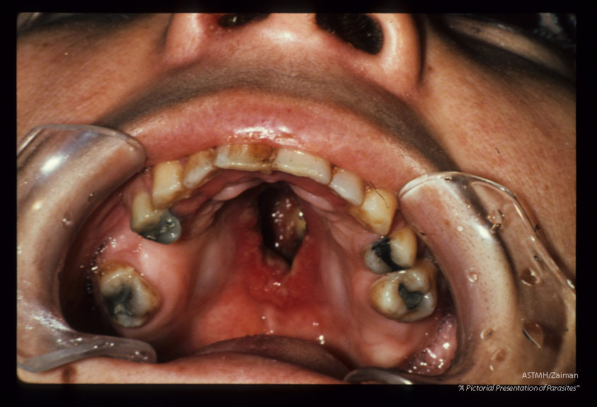 Mucocutaneous (Peru). Destruction of hard palate.