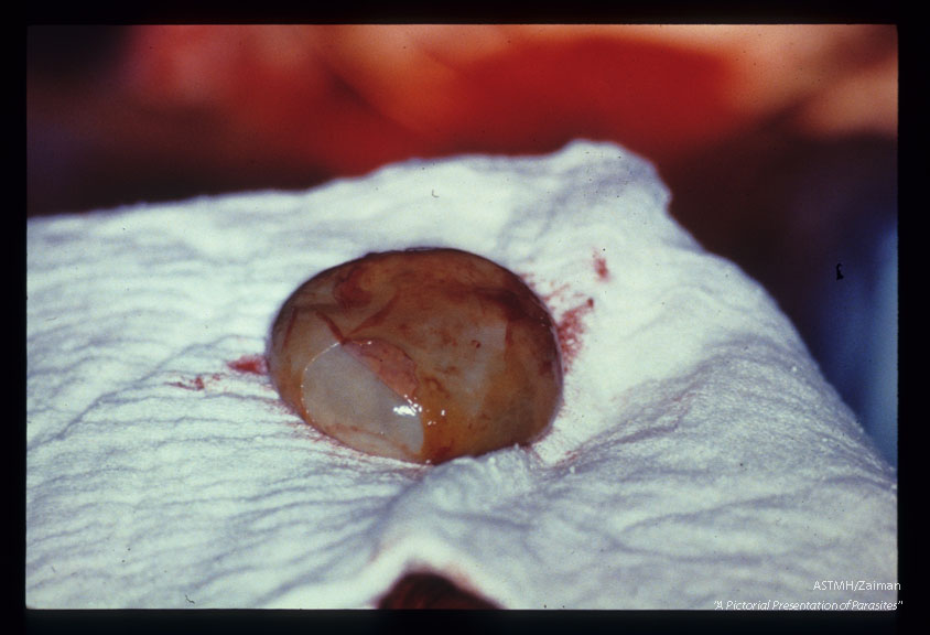 A 26 year old Italian male presented with jaundice due to biliary tree obstructions by daughter cysts of Echinoccocus granulosus. Picture sequence of operative dissection. Removal of cysts, placement of multiple drains and creation of several anastomoses were required to ensure proper biliary drainage and to prevent bile peritonitis.