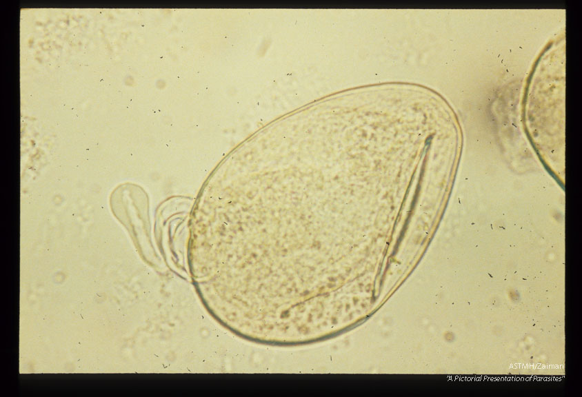 Egg with circumoval pre cipitate.