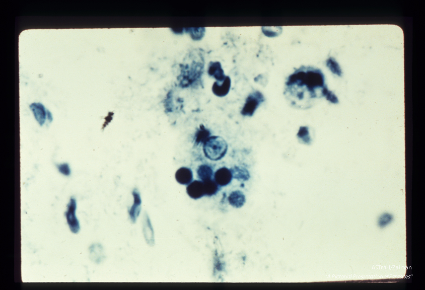 Trophozoites . iron hematoxylin stain. Each specimen has engulfed red blood cells which stain darkly.