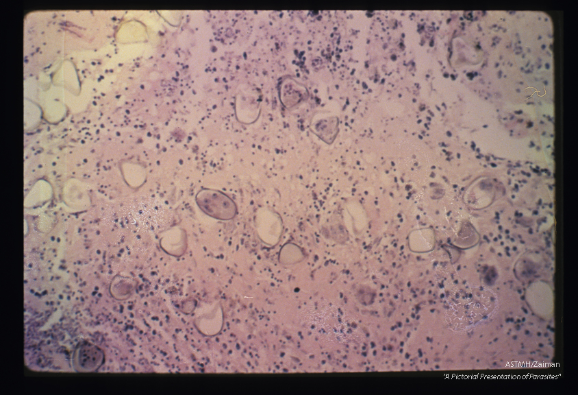 Eggs in human brain. At higher power the egg shells and spaces they surround are readily seen. Giant cells have replaced some of the egg contents.