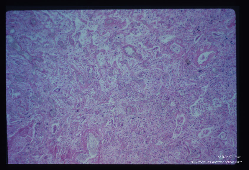 Wall of pulmonary abscess.