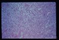 Wall of pulmonary abscess.
