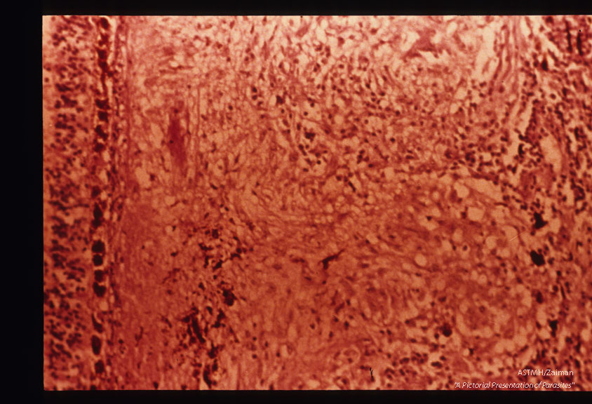 Toxoplasmic retinochoroiditis showing closeup of granulomas in choroid. Organisms were present in retina. Same eye as 1056.