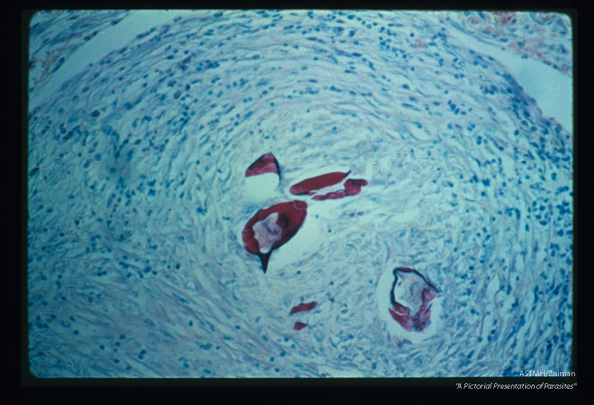 The acid fast character of the egg in this granulomatous reaction is striking.