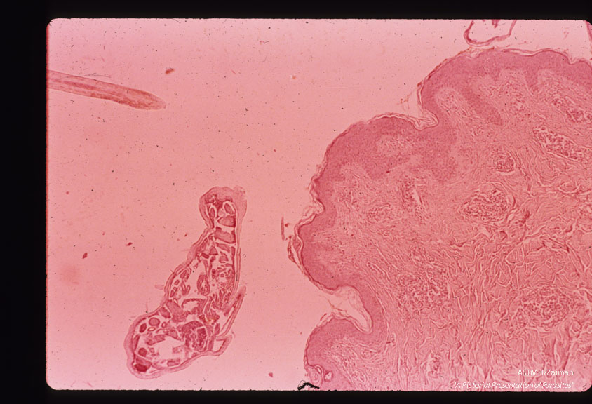 Skin biopsy showing arthropod and inflammatory reaction in skin.