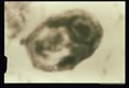 Cysts from patients in Venezuela.