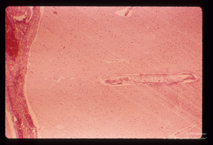 Nematode in human brain.