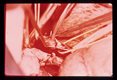 Mobilization of hepatic vein and insertion of tubing leading to bypass filter.