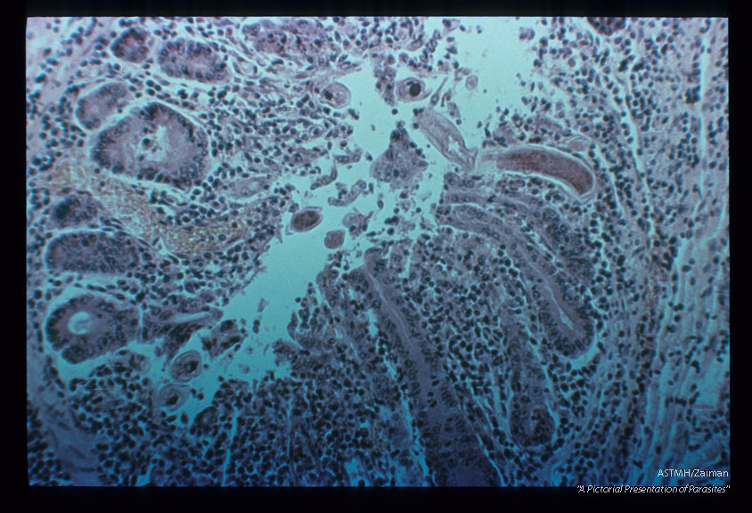 Same case. Portion of adult.