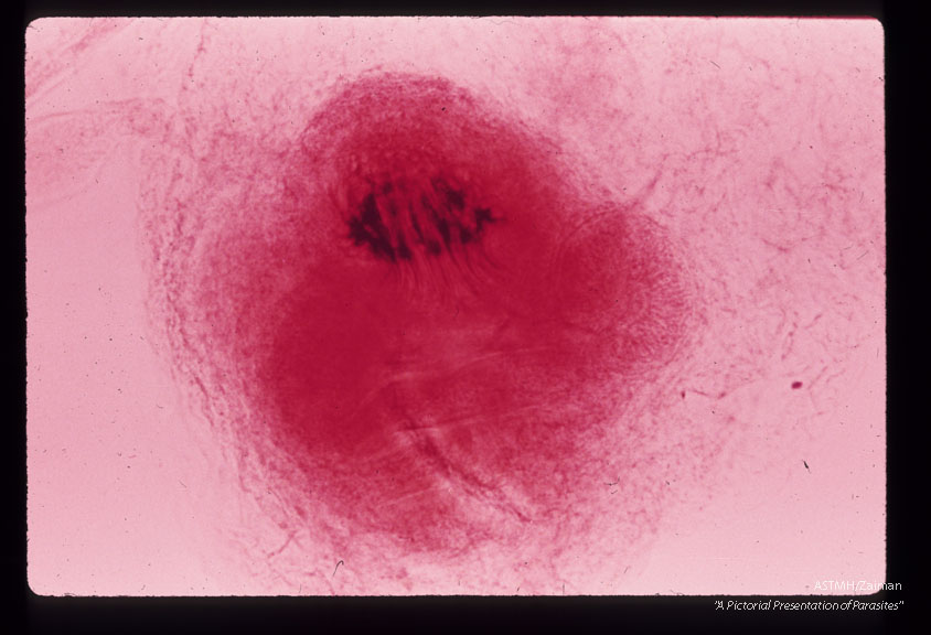 A 32 month old white male in South Dakota suffered progressive lassitude,   anorexia,   irritability,   incoordination and infrequent vomiting.  A suboccipital craniotomy was performed during which a grape-like mass of translucent thin wall cysts was discovered and partially evacuated with difficulty.  Subsequently patient developed flexion rigidity of the  extremities,  non-reactive pupils and decreased consciousness.  A sinus tract at the operative site con­tained more cysts.  The patient died three months after the onset of symptoms.  Higher power views of one scolex.