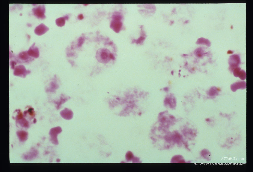 Microscopic views of amebae in brain lesions.