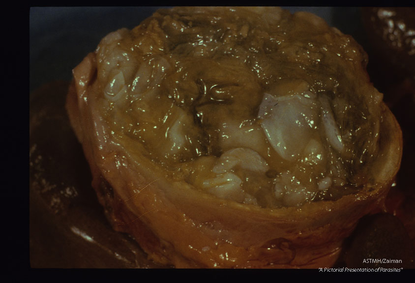 Liver cyst.