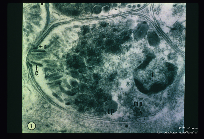 Ultrastructure of parasite in human heart muscle. This photograph shows the nucleus (n), the polar ring (r), the conoid fc), a convoluted tubule (tp) and the micropyle (mp) fairly well.