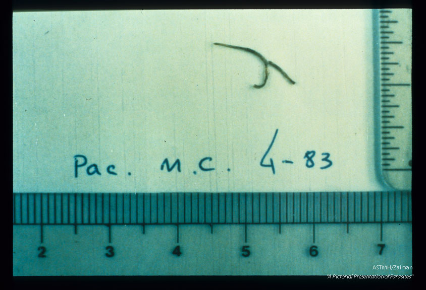 Two adults in classical Y arrangement were coughed up by a patient who complained of tickling in the throat.