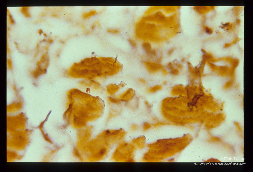 Spirochaetes in myocardial tissue. Dieterle stain.