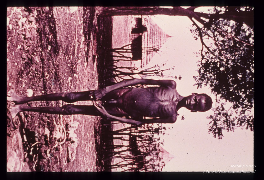 Severe, terminal emaciation in kala azar.