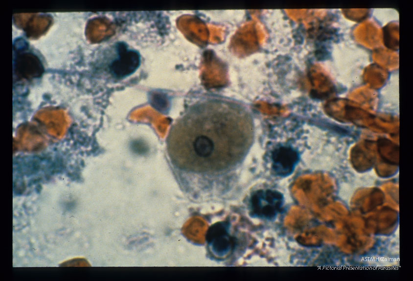 Multiple Pap smear fields from the cervix of the same patient. Various magnifications.