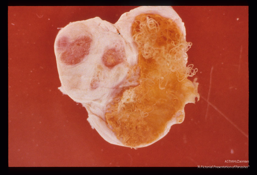 Onchocercoma extirpated from a young man in Liberia. On one side of the nodule is a cavity with many living worms. On the other side a stronger host reaction is present with a few worms embedded in the soft tissue. (Diameter 5 cm) Liberia.