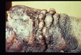 Elephantiasis, penetrating ulceration, heavy verrucal hyperkeratosis (