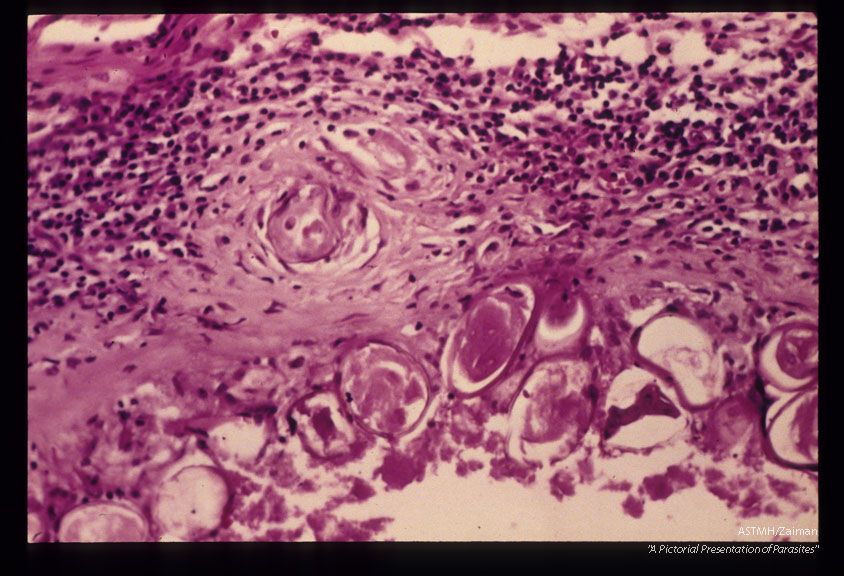 Egg within a granuloma in a lung.