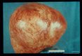 Intraperitoneal cyst. CT scan (1529) and surgical specimen.