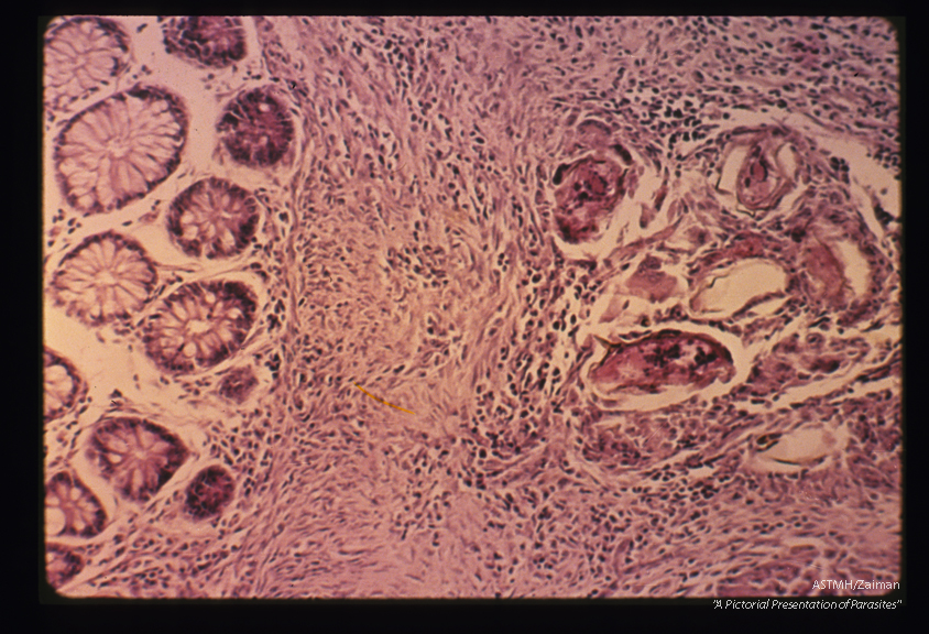 Eggs in H & E preparation of bowel. One of the eggs in this granuloma shows a lateral spine nicely.