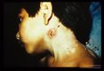 Neck abscess in 7 year old girl which drained approximately fourty nematodes. Each about one cm. long.