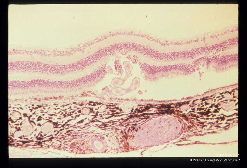 Subretinal larva and outer retinal disruption in an experimentally infected cynomolgus monkey.