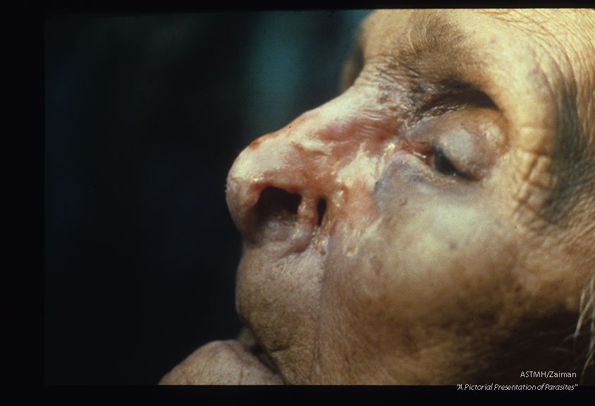 Nasal myiasis.