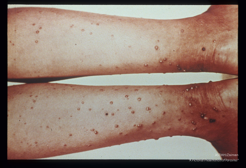 Verrucous eruption on legs, nodular type.