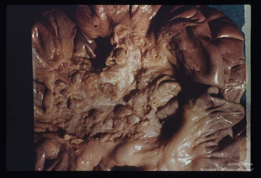 Gross pathology. Lymphadenopathy associated with infection.