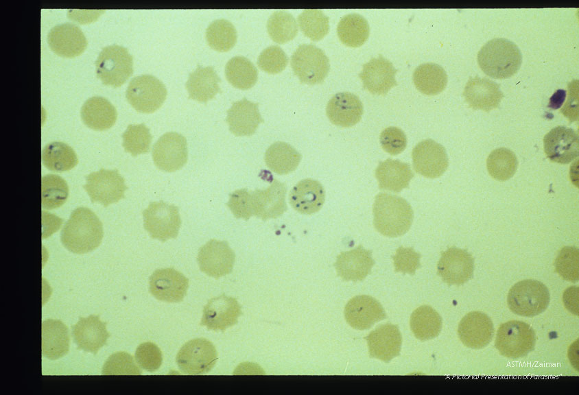 Giemsa stained slides from a fatal case on Fire Island, N. Y., (1982). The parasitemia is high for human babesiosis. Budding, multiply-infected erythrocytes, tetrad formation, band forms, reticulocytosis and clumping of extracellular parasites may be seen.