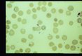 Giemsa stained slides from a fatal case on Fire Island, N. Y., (1982). The parasitemia is high for human babesiosis. Budding, multiply-infected erythrocytes, tetrad formation, band forms, reticulocytosis and clumping of extracellular parasites may be seen.
